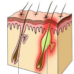 folliculitis-hair-follicle-picture.jpg